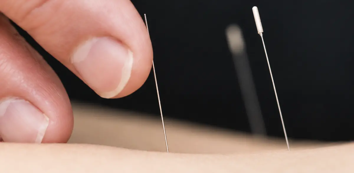 Acupuncture treatment